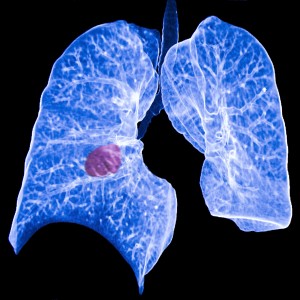 ct scan of blue lungs with red growth RDS Environmental Colorado